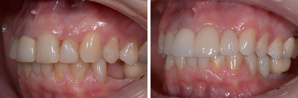 Chirurgia implantare: prima e dopo